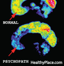 Psichopatinės smegenys buvo tyrimų sritis, siekiant nustatyti, kaip galvoja psichopatai, tačiau kuo skiriasi psichopatų smegenys?