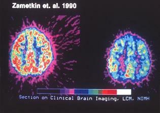 klinikinis smegenų vaizdų nuskaitymas adhd