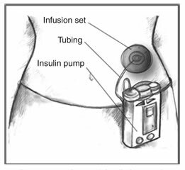 Insulino pompa