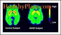 Sąvokos ADD ir ADHD buvo vartojamos pakaitomis. Tačiau atnaujintas terminas, remiantis DSM IV, yra ADHD (dėmesio deficito hiperaktyvumo sutrikimas).